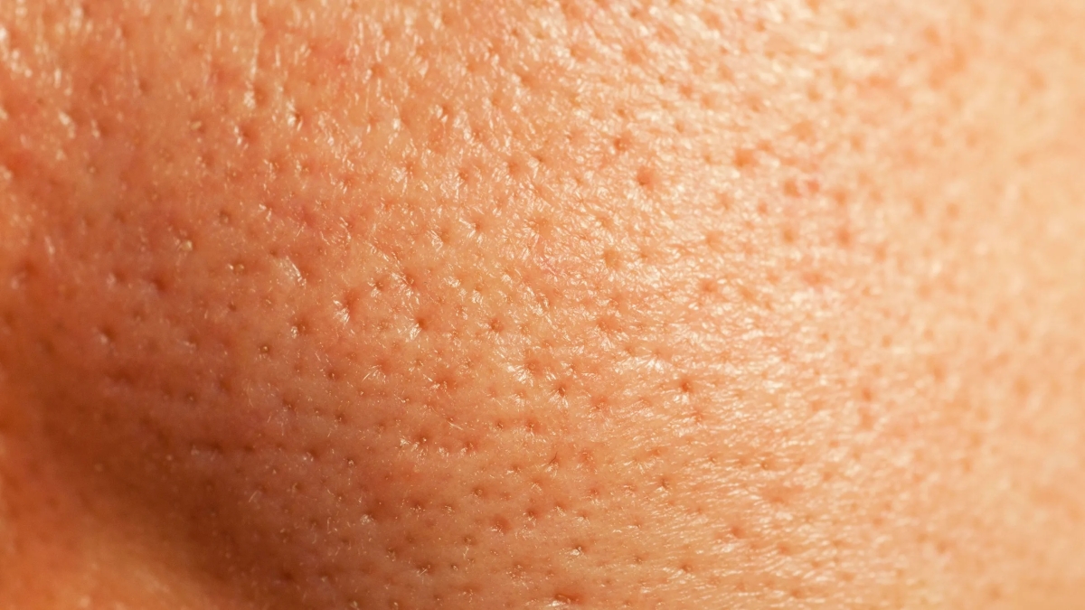 Que sont les Pores ? Comment se Débarrasser des Pores Dilatés : 3 Façons