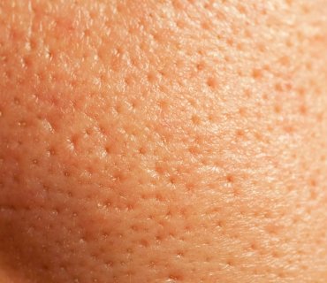 Was sind Poren? Wie man Große Poren Loswird: 3 Wege