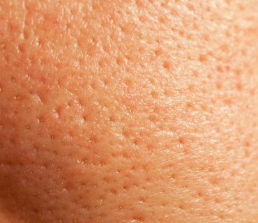 Que sont les Pores ? Comment se Débarrasser des Pores Dilatés : 3 Façons